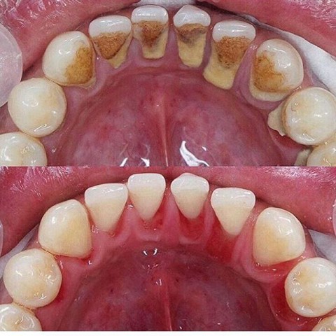 Tártaro \ Cálculo Dental