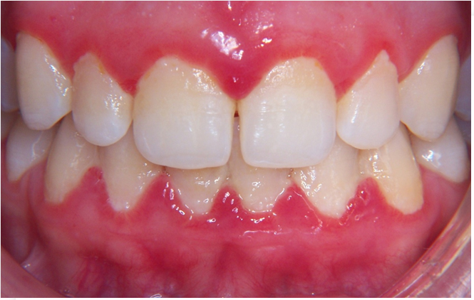 Placa Bacteriana